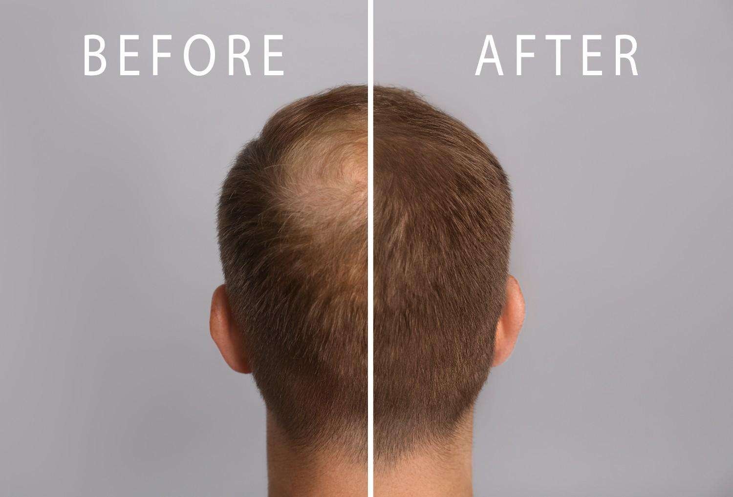 hair-transplant-result-a